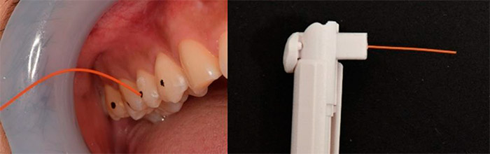 歯根膜感覚測定風景と測定装置