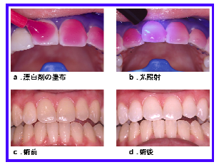 歯 を 白く する